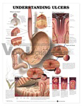 Understanding Ulcers Anatomical Chart